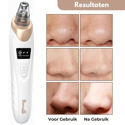CHES | Premium Blackhead Remover