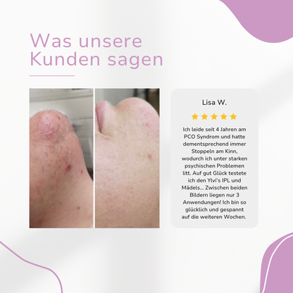 CHES | IPL Hair Remover